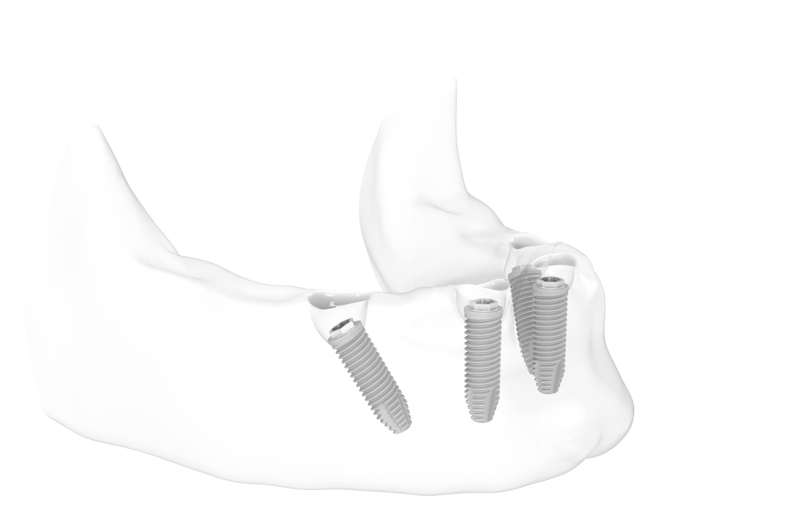 All-on-4: vier Implantate im Kiefer, die hinteren schräg gesetzt