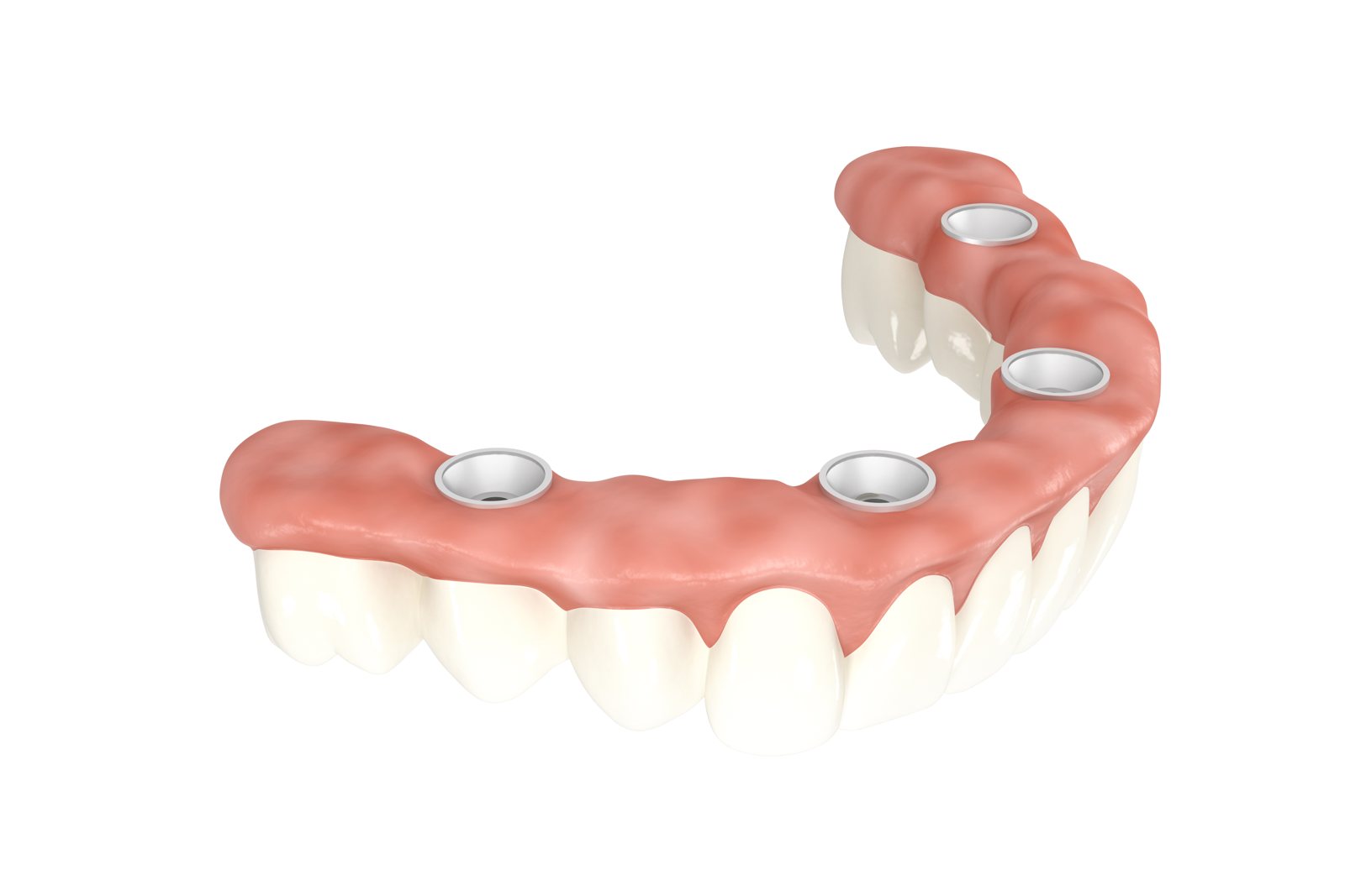 Illustration: provisorische Brücke, fest auf den Implantaten verschraubt